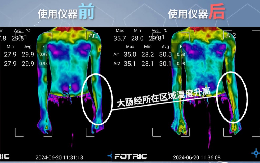 热像仪检测大肠经温度升高.jpg